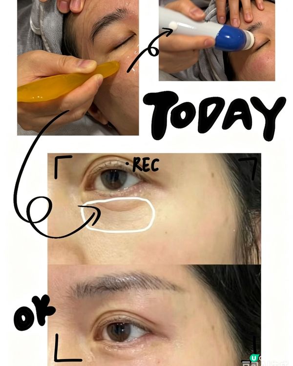 眼周初老救星✨！眼部 DEP 療程
