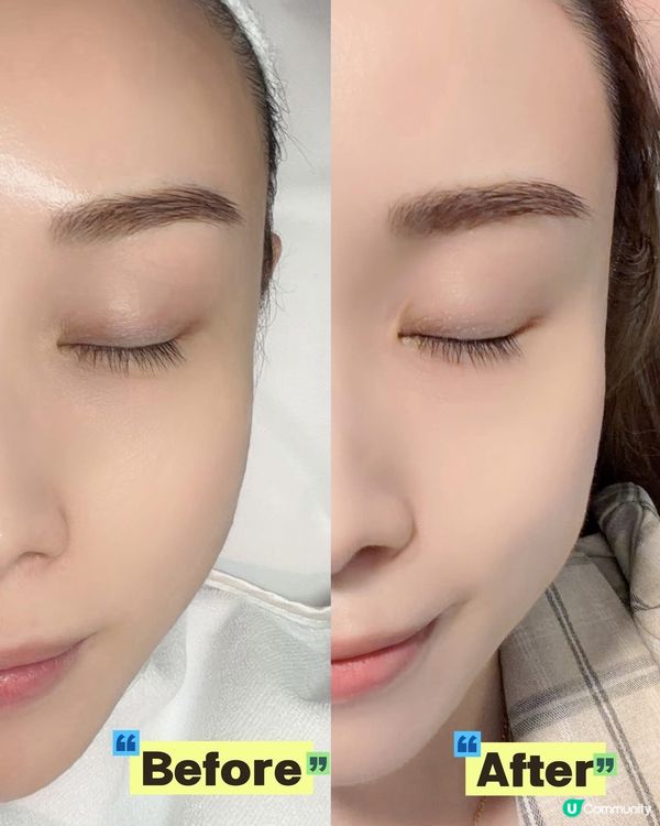 💎 告別暗黃暗沉!西班牙 TDC 基因美白 × 無針水光槍 ...