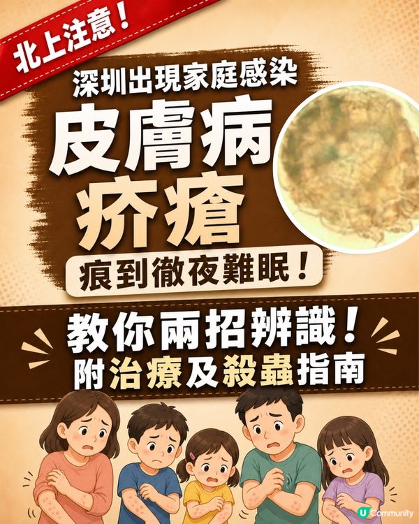 深圳現「疥瘡」感染個案🚨潛伏期無病徵照樣傳播！兩步辨識+治療消毒指南