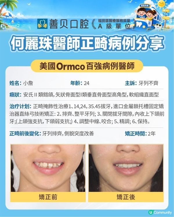 深圳箍牙真人實測 |24歲安氏二類錯颌 兩年箍牙前後對比 | 箍牙方案詳解 | 善貝口腔暑期箍牙大激賞
