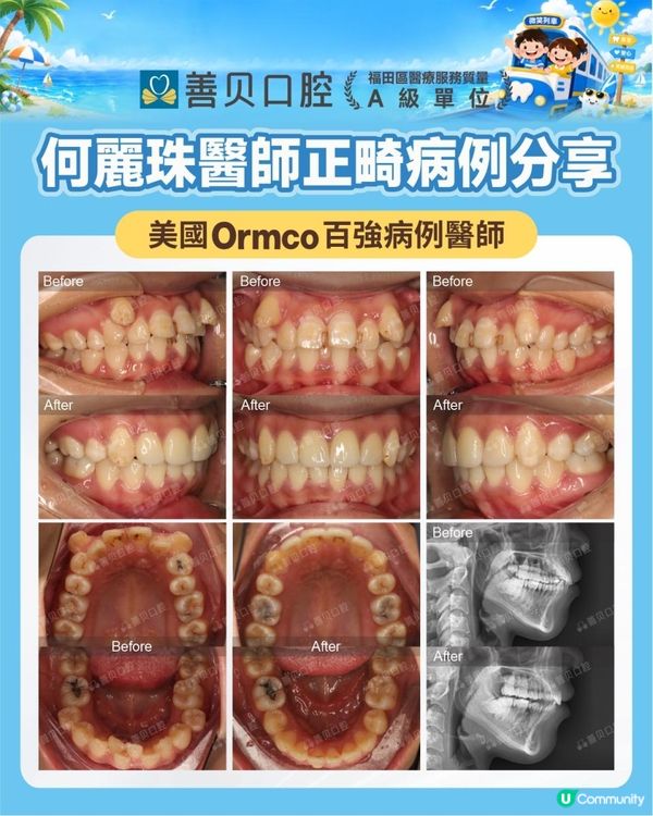 深圳箍牙真人實測 |24歲安氏二類錯颌 兩年箍牙前後對比 | 箍牙方案詳解 | 善貝口腔暑期箍牙大激賞