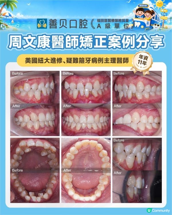 🦷 25歲北上深圳善貝口腔｜倒及牙矯正大成功！