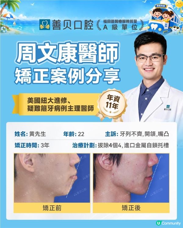 過咗青春期，嘴凸仲矯正唔矯正到？深圳資深牙醫師 | A級醫療機構 | 善貝口腔成人嘴凸 | 哨牙個案分享 | 箍牙方案 | 箍牙時間 | 箍牙效果