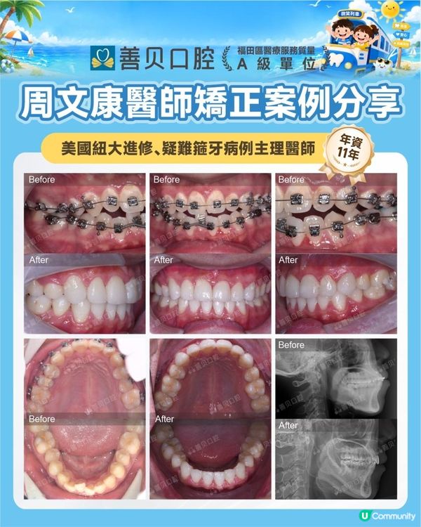 過咗青春期，嘴凸仲矯正唔矯正到？深圳資深牙醫師 | A級醫療機構 | 善貝口腔成人嘴凸 | 哨牙個案分享 | 箍牙方案 | 箍牙時間 | 箍牙效果