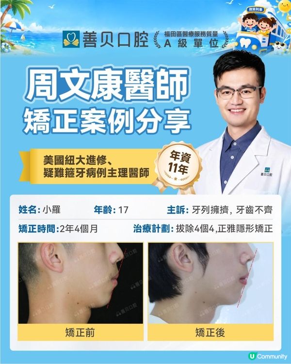18歲箍牙2年4個月大變身！深圳善貝口腔真實個案分享🦷