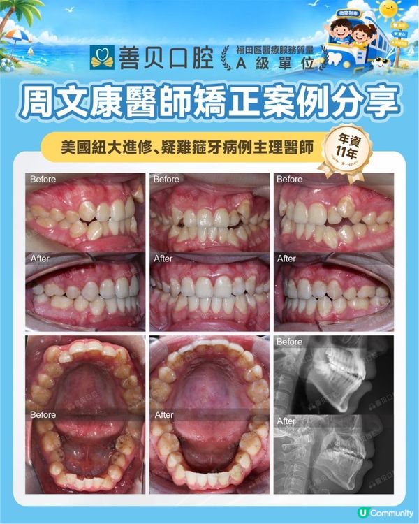 18歲箍牙2年4個月大變身！深圳善貝口腔真實個案分享🦷