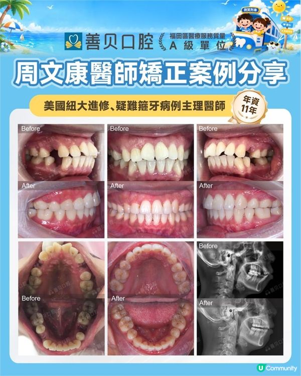 深圳箍牙牙科推薦｜善貝口腔醫師．案例．服務．位置．收費全面睇