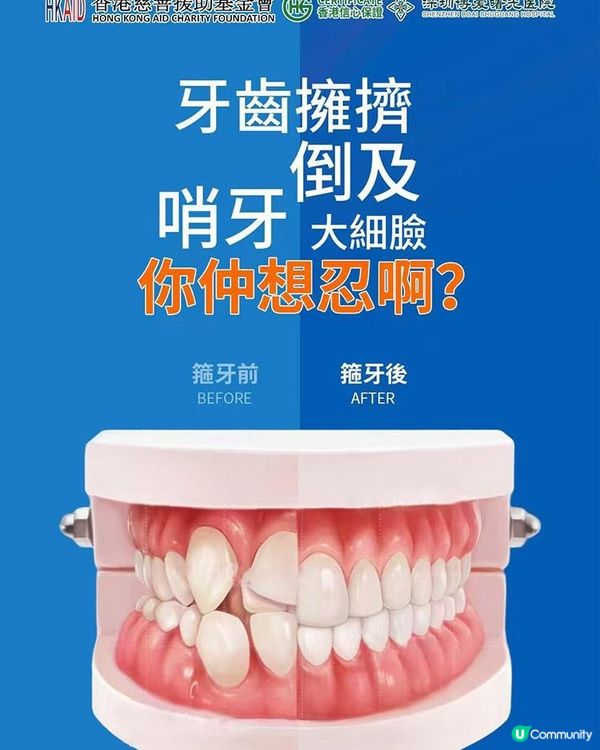 港人箍牙點揀？金屬、隱形牙箍分別同適合人群拆解