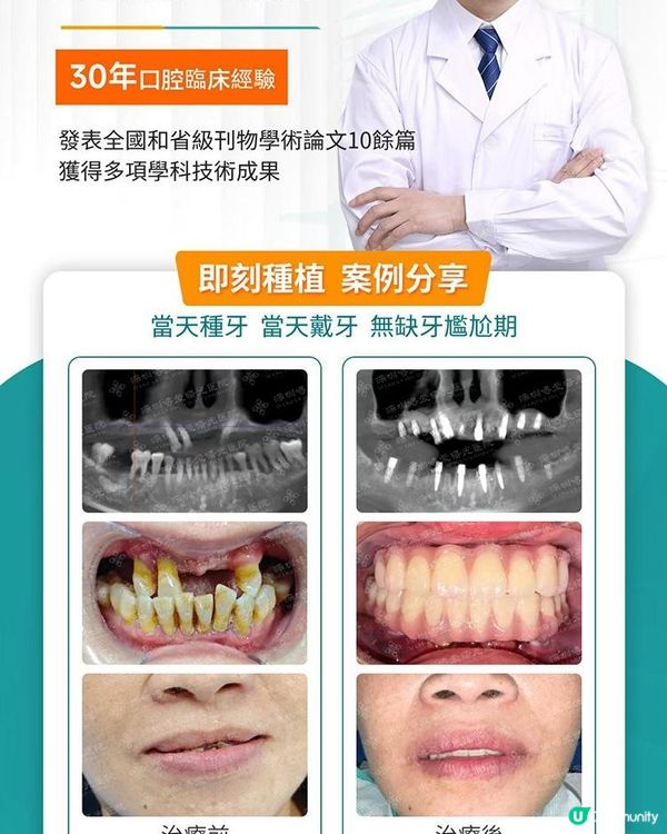 全口牙鬆動 5 年食嘢困難？即拔即種 + 鼻竇提升當日即刻戴牙真實個案