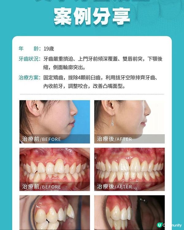牙齒擁擠、唇部前突一定要拔牙矯正嗎？真實個案參考