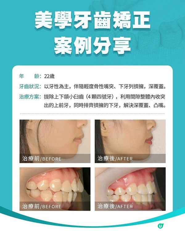牙齒矯正個案｜牙性為主伴輕度骨性嘴突，拔牙矯齒治療參考