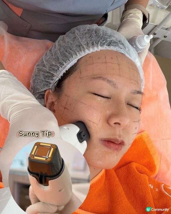 無創無痛膠原增生！MEDSKIN PLUS+ X SunnyRF 全方位提拉