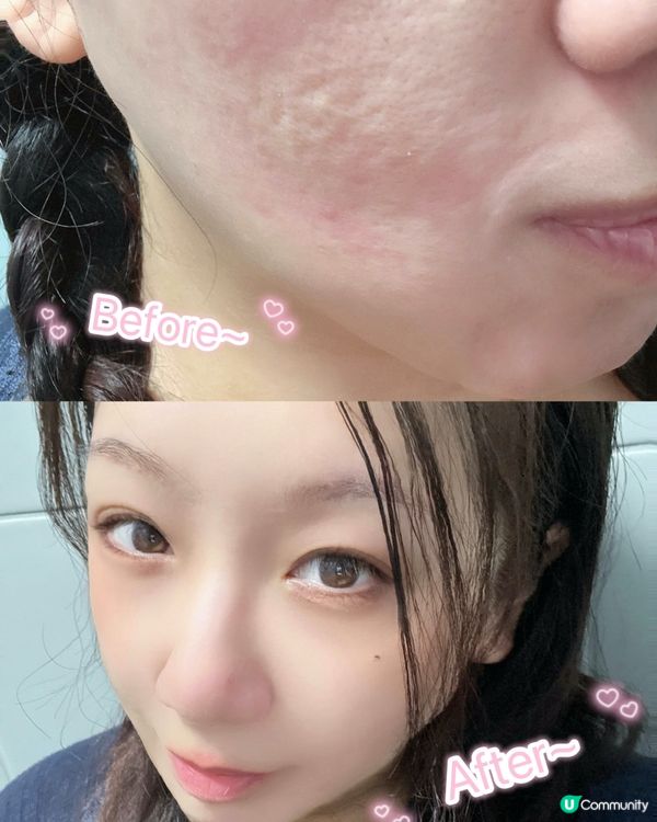 塊面易過敏同埋成日爆豆嘅手足入嚟！！😭
