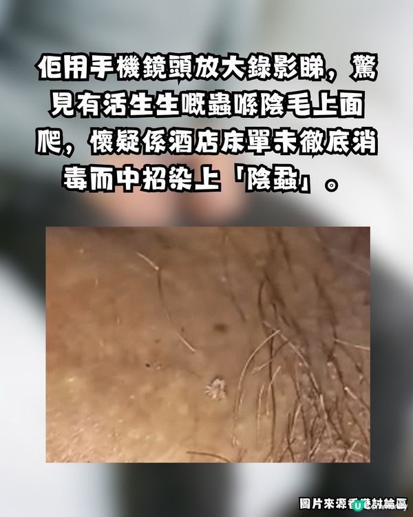 深圳酒店疑爆陰蝨 😱港爸返港後私處持續痕癢驚見活蟲 🐛附3大預防建議