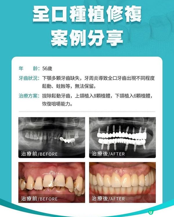 全口種植修復真實個案｜牙周病導致牙齒鬆動，重獲咀嚼能力