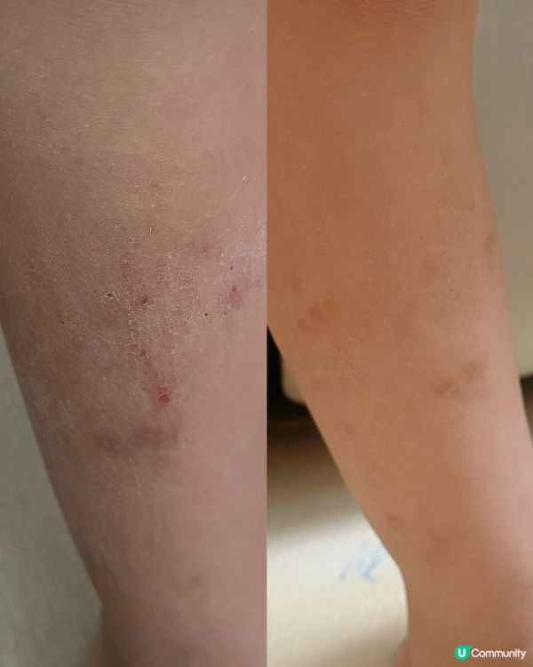好使好用！乾敏肌救星 ✨👧
