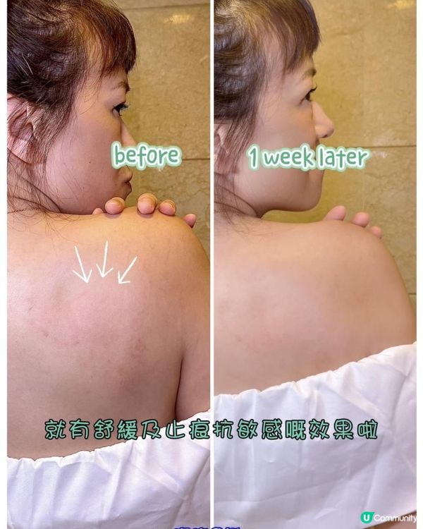 轉天氣使皮膚乾燥/泛紅嘅止痕秘密武器