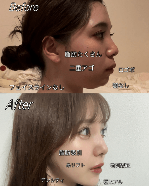 日本護士花10年整容減肥逆襲成女神😮使40萬抽脂惹熱議💬稱要整到無猶豫為止❗️