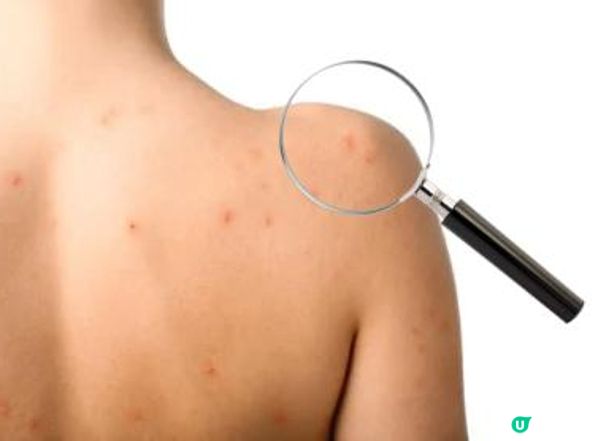 解鎖嫩滑肌膚的胸前美背誘滑組合，背部胸口暗瘡無得留底！