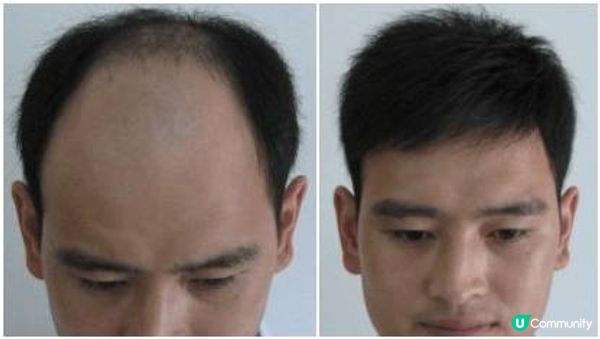 男士親身經歷洗白黑店：Hair Again 和 Perfect Men真被網民害慘了！沒想到這款生髮那麼神，短期內就徹底擺脫了脫髮危機！