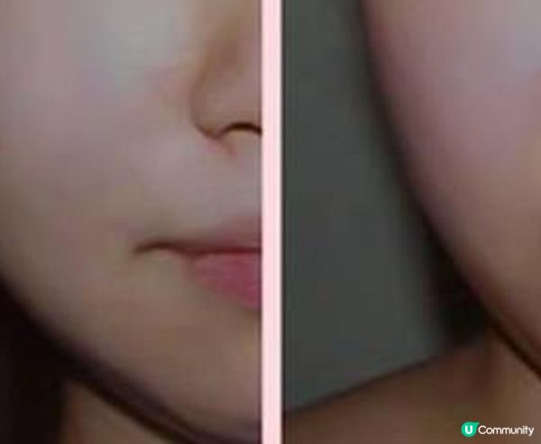 我的收雙下巴之旅！Hifu treatment瘦面分享