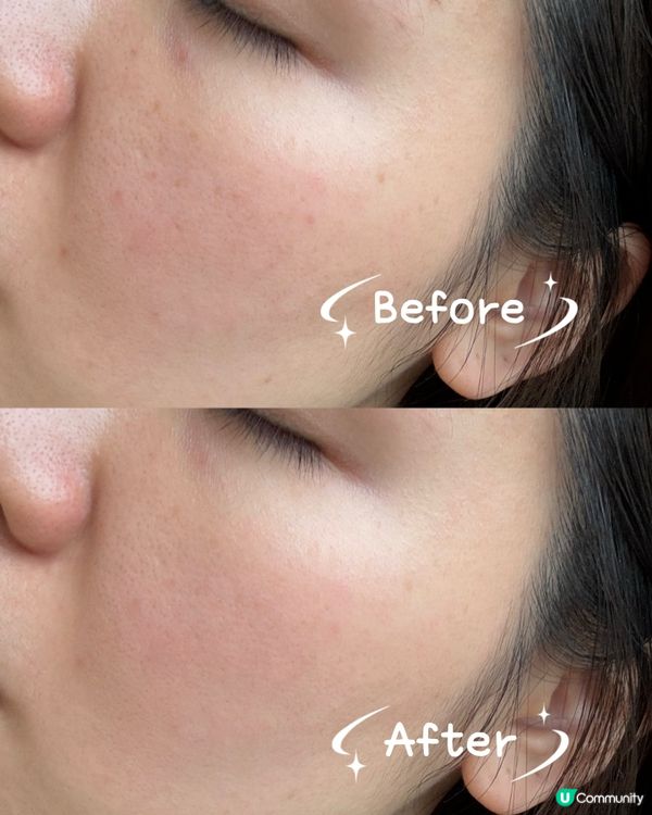 1.  痘印走開👋！2步煥膚美白，告別花面貓！✨