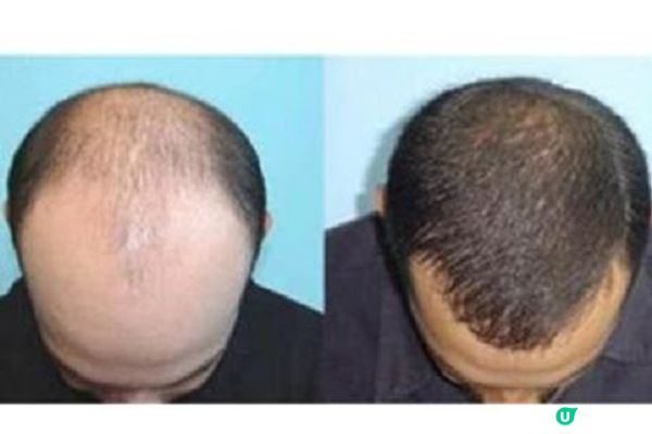 生髮療程大PK：該選多功能的 Hair Forest POWER 激髮療程 or 單一強效增髮的 Perfect Men F8生髮療程？做不出決定不妨先參考這篇分享文，實測這款更驚豔！