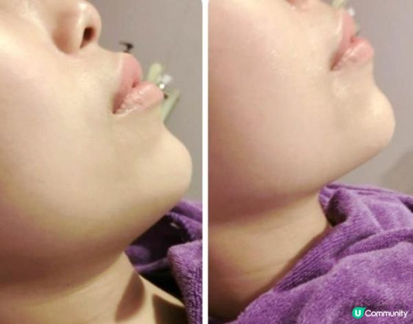 驚人嘅firming小顏術 顛覆已有認知的HIFU效果