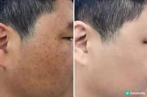 醫美激光能100%安全去凹凸洞和色斑？熟男親測體驗分享：LIGHTMAC & Perfect Men，這款短期內高效嫩膚淡斑，還不帶任何副作用！
