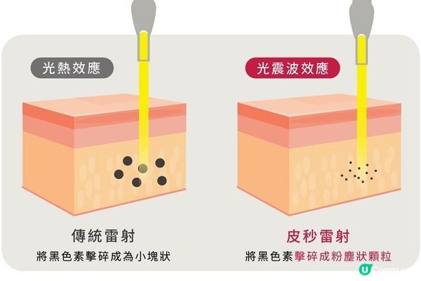 去斑去到皮膚都好咗？皮秒去斑的威力遠超過你想像！