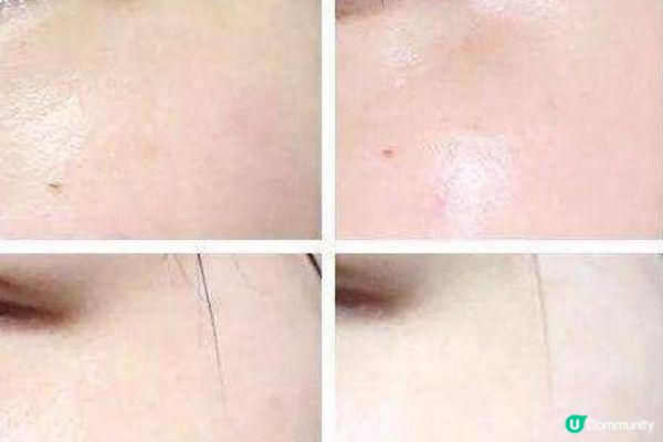 去斑去到皮膚都好咗？皮秒去斑的威力遠超過你想像！