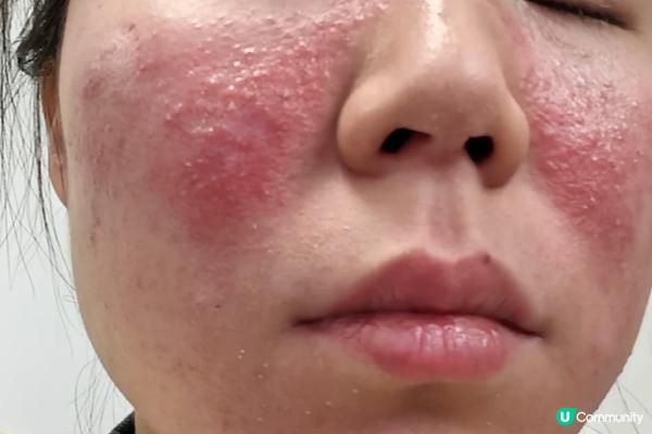 玫瑰痤瘡能斷尾嗎？皮膚科醫師解析玫瑰痤瘡成因、症狀、藥膏治療選擇