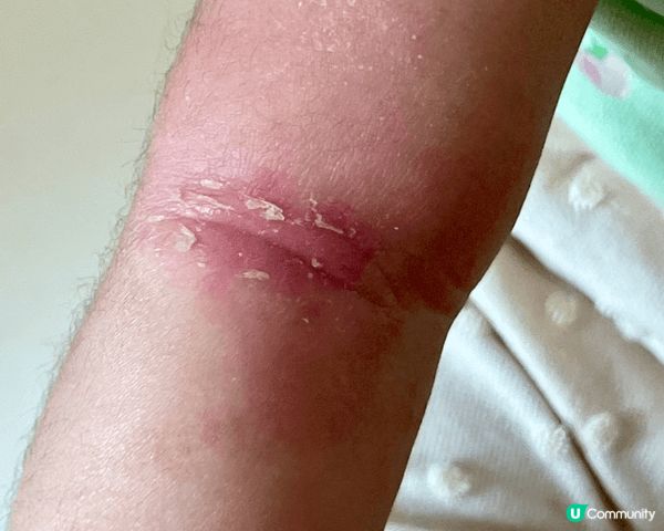 見到BB濕疹成日r到紅晒、損晒，真係做媽媽嘅心都痛埋。試咗搽...