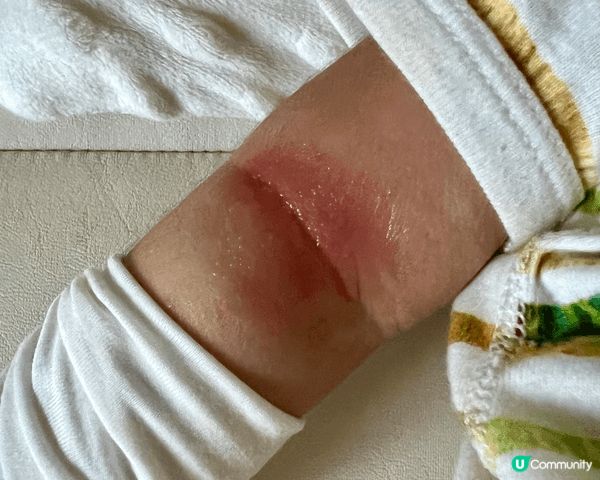 見到BB濕疹成日r到紅晒、損晒，真係做媽媽嘅心都痛埋。試咗搽...