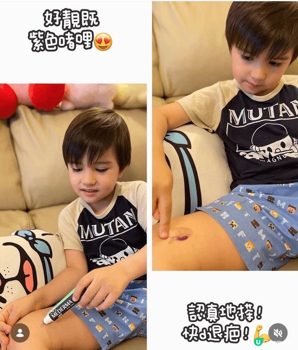 小朋友成日周圍跑跑跳跳，好容易整親🤕！而家天氣又開始熱，d蚊...