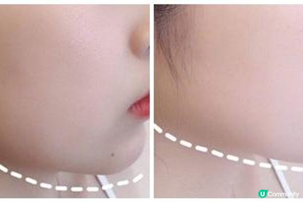 想緊膚提拉，Thermage Flx vs HIFU點揀好？