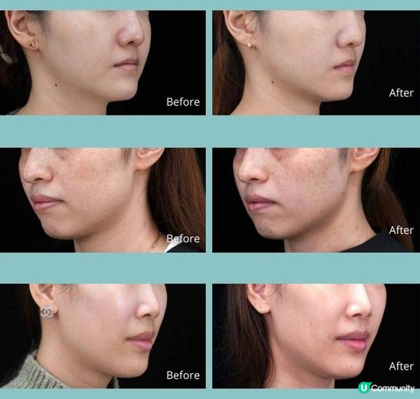 警世！貪靚瘦面千祈唔好貪平北上做醫美！