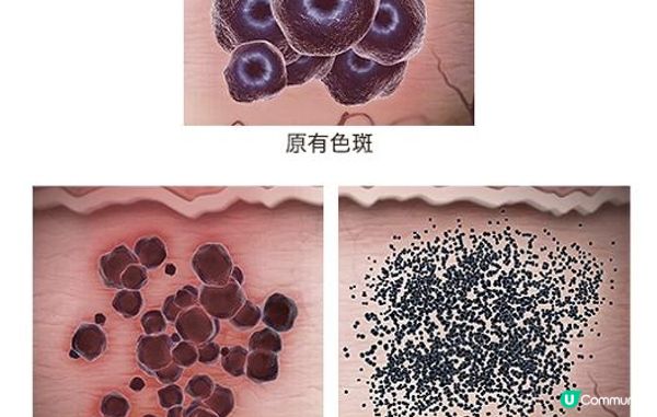 大癲！Picolaser副作用原來係……