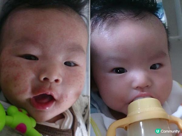 【真實分享】3星期鱷魚油試用：寶寶的濕疹紅癢終於有轉機了 🐊✨