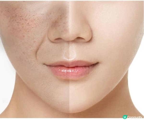 皮秒去斑價錢2024