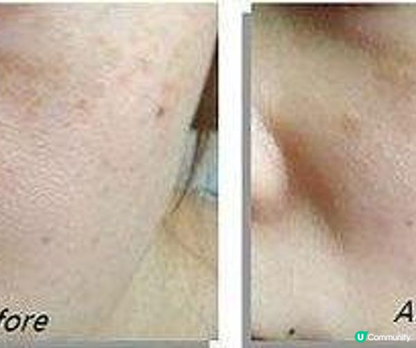 皮秒去斑價錢2024