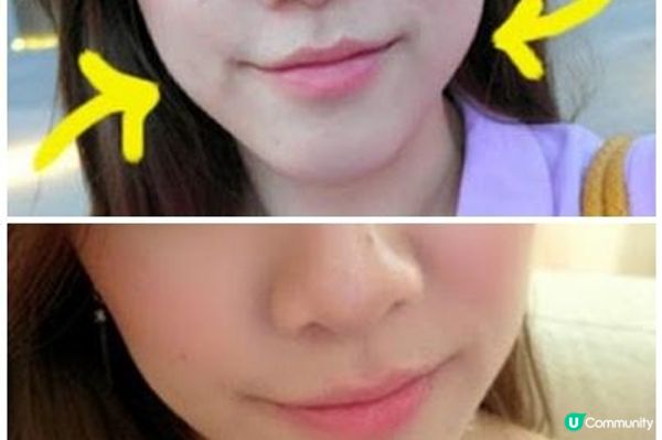 聽人講HIFU打得密，副作用係會打凹塊面？係真咩？