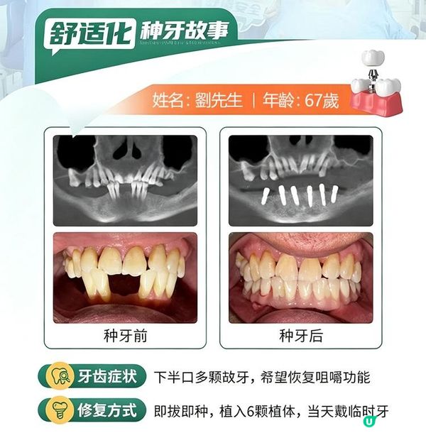 舒適化無痛種牙｜下半口缺牙即拔即種真實案例｜深圳博愛曙光醫院