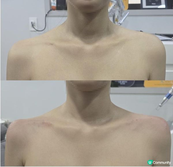 🛑 救命呀！明明好瘦，穿吊帶衫一秒變「大隻妹」？原來你少了一條神仙鎖骨線！