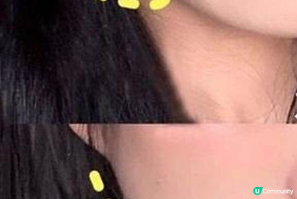 香港HIFU最新科技 HIFU GOLD 黃金索你試咗未？