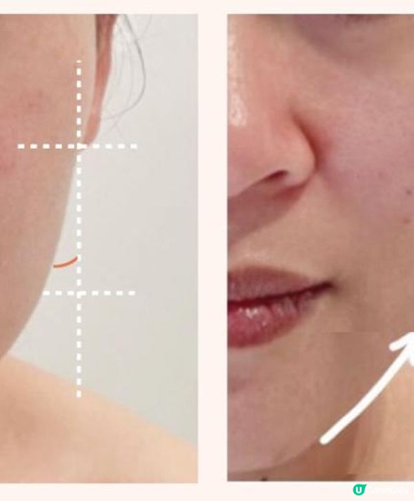 年度必做醫美療程~V面輪廓提昇法寶~HIFU Gold