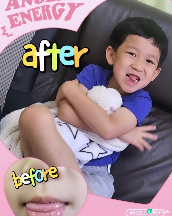 生痱滋唇瘡 救星