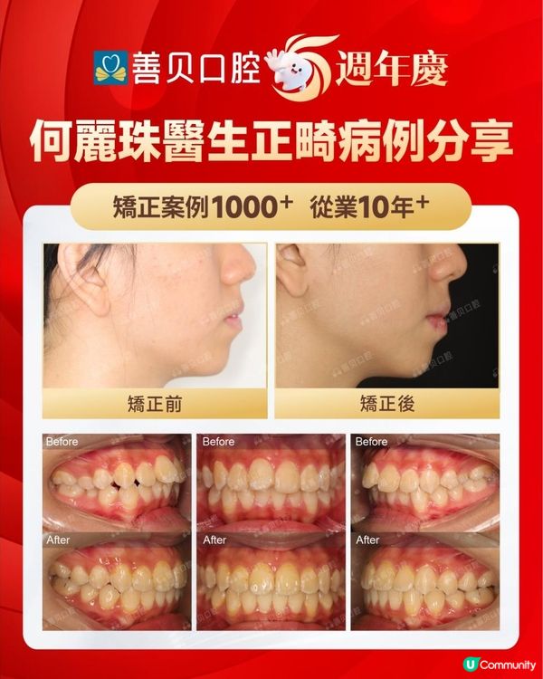 【深圳箍牙】不剝牙箍牙，善貝口腔真實個案