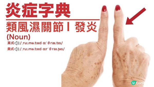 類風濕性關節炎