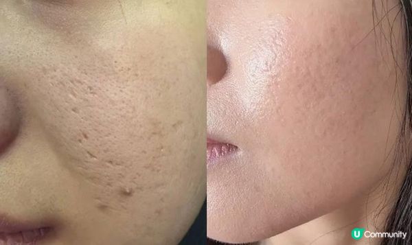 新機Sylfirm X矽谷電波 K.O. 凹凸洞效果：絕呀！只係一次皮膚滑返唒！